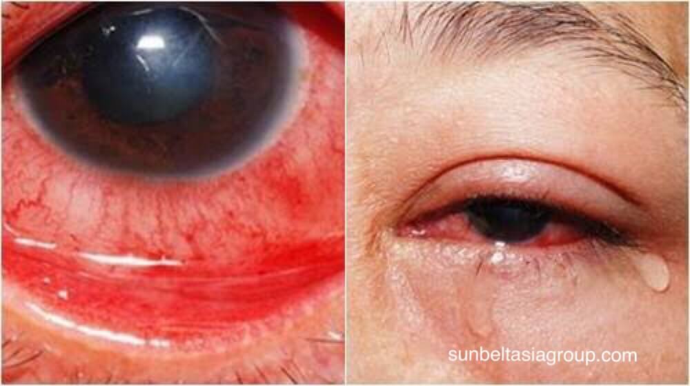 โรคตาแดง ตาสีชมพู (เยื่อบุตาอักเสบ) คือการอักเสบหรือการติดเชื้อของเยื่อโปร่งใส (เยื่อบุตา) ที่เรียงเป็นแนวเปลือกตาและปิดส่วนสีขาว