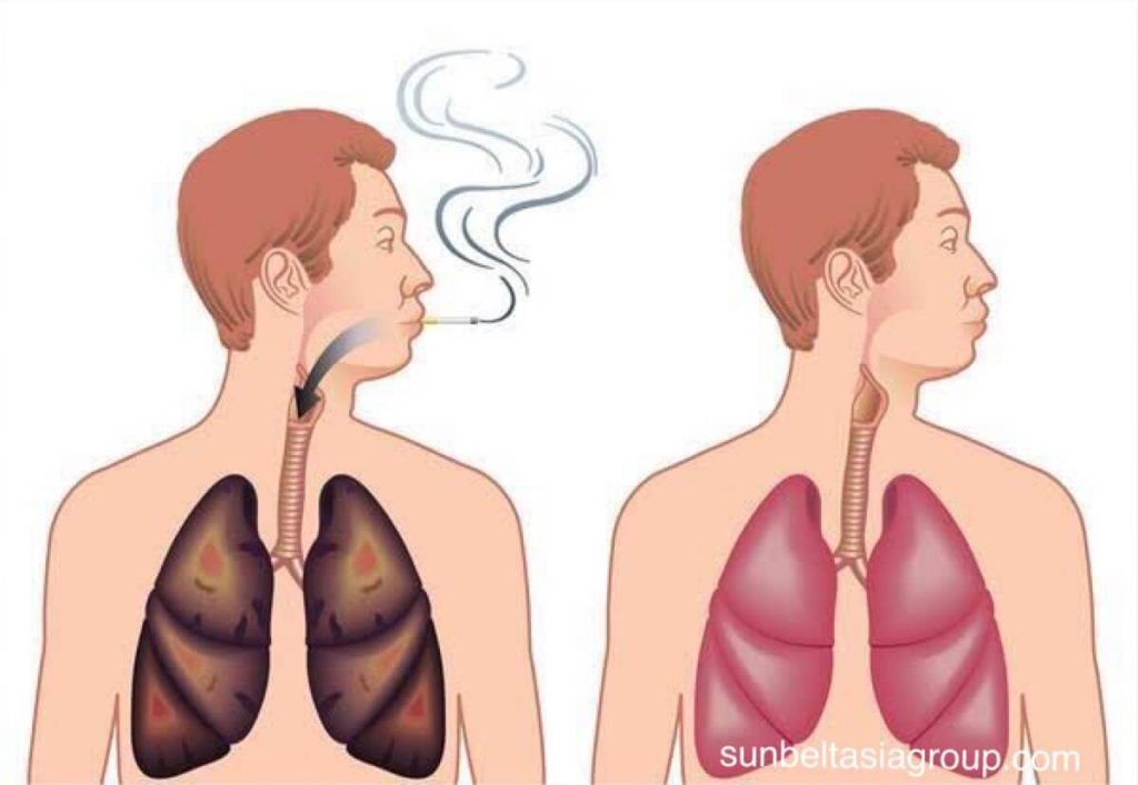 ภาวะอวัยวะเป็นภาวะปอดที่ทำให้หายใจถี่ ในคนที่เป็น โรคถุงลมโป่งพอง ถุงลมในปอด (alveoli) จะเสียหาย เมื่อเวลาผ่านไป