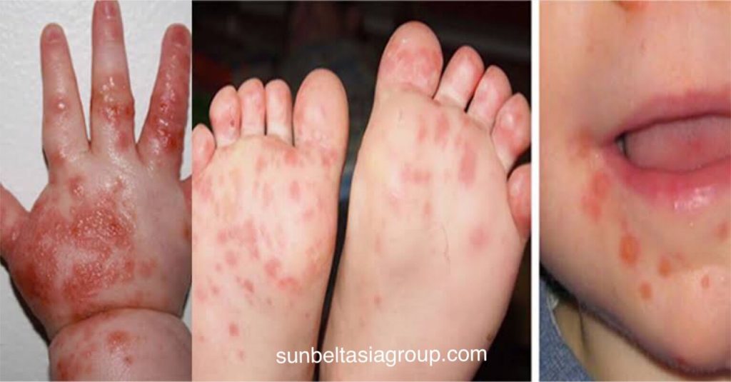 โรคมือเท้าปาก การติดเชื้อไวรัสที่ไม่รุนแรงและติดต่อได้ทั่วไปในเด็กเล็ก  มีลักษณะเป็นแผลในปากและมีผื่นที่มือและเท้า โรคมือเท้าปากมักเกิดจาก