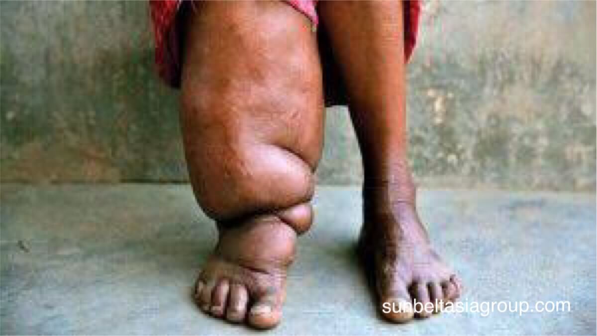 โรคเท้าช้าง หรืออวัยวะร่างกายขยายตัว