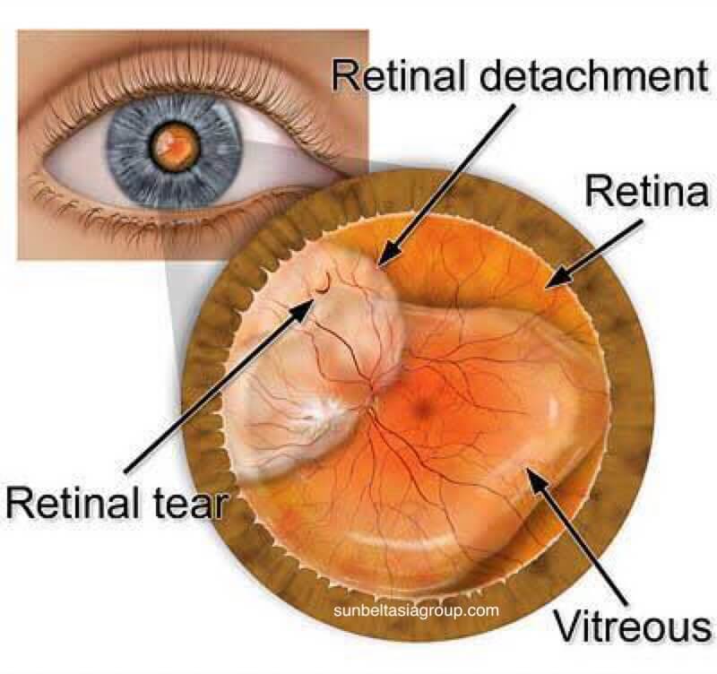 การเสื่อมสภาพของ วุ้นตาเสื่อม หมายถึงการเปลี่ยนแปลงที่เกิดขึ้นในน้ำวุ้น ตา (หรือของเหลวในน้ำวุ้นตา) ในดวงตา เนื่องจากน้ำวุ้นตา