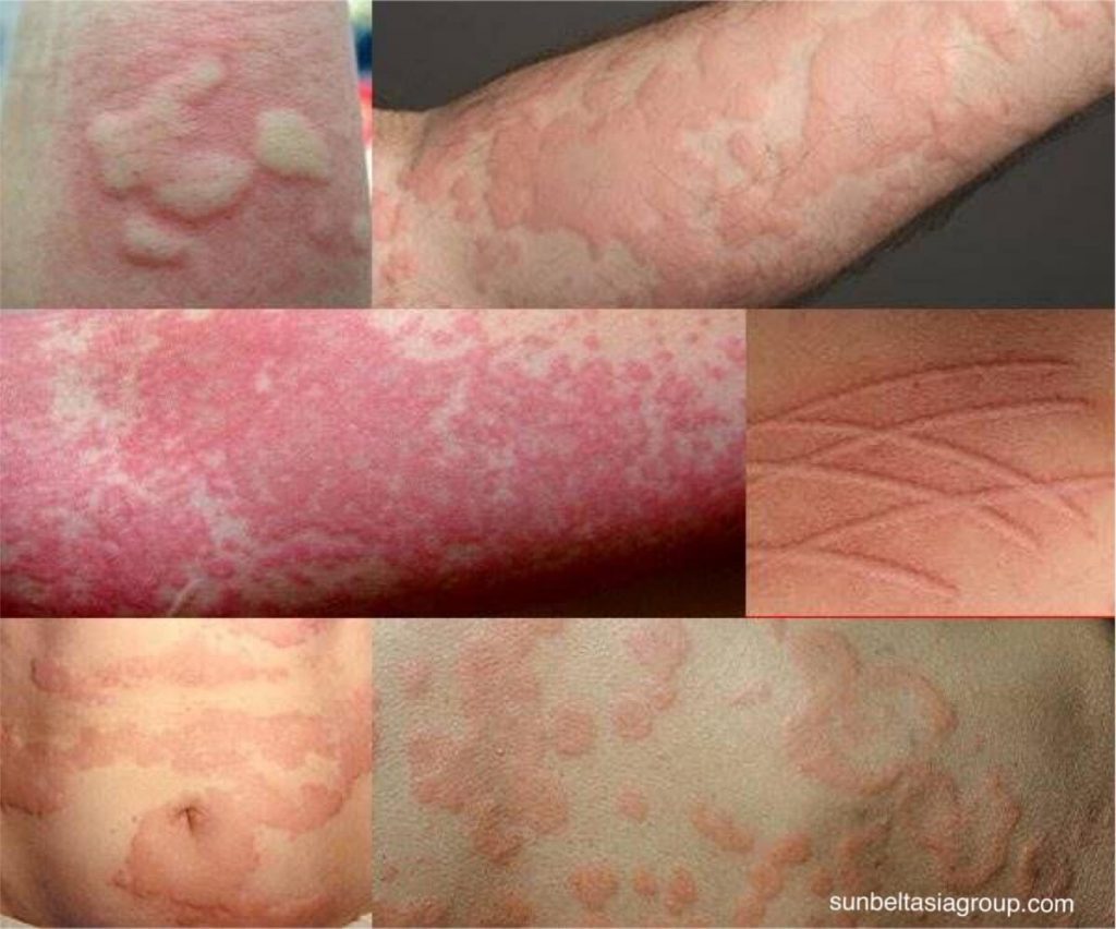 โรคลมพิษ เป็นรอยหยักสีแดงแบนๆ ซึ่งสามารถปรากฏได้ทุกที่บนผิวหนังและมักมีอาการคัน ลมพิษมักเกิดขึ้นจากปฏิกิริยาแพ้กับสิ่งที่กิน