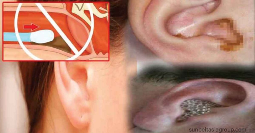 ขี้หูอุดตัน เกิดขึ้นเมื่อขี้หู (cerumen) สะสมในหูของคุณหรือยากเกินไปที่จะล้างออกตามธรรมชาติ ขี้หูเป็นส่วนที่เป็นประโยชน์และเป็นธรรมชาติ