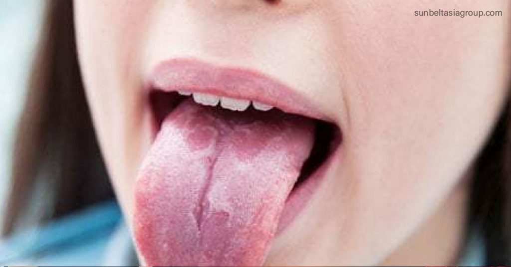เชื้อราในช่องปาก หรือที่เรียกว่าเชื้อราในช่องปาก เป็นภาวะที่เชื้อรา Candida albicans สะสมอยู่ที่เยื่อบุปากของคุณ เป็นสิ่งมีชีวิตปกติในปาก