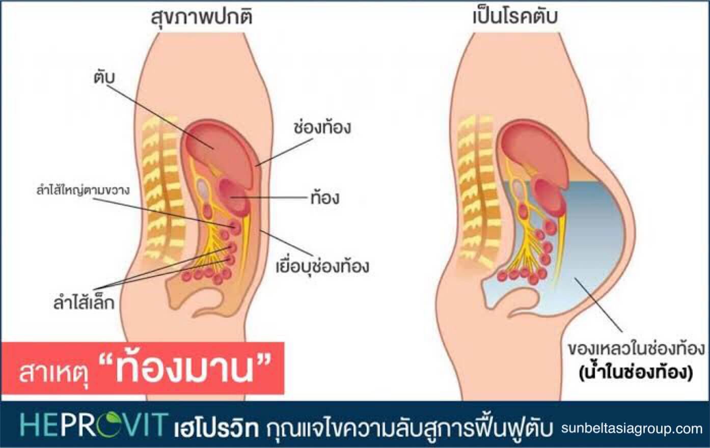 น้ำในช่องท้อง หรือท้องมาน