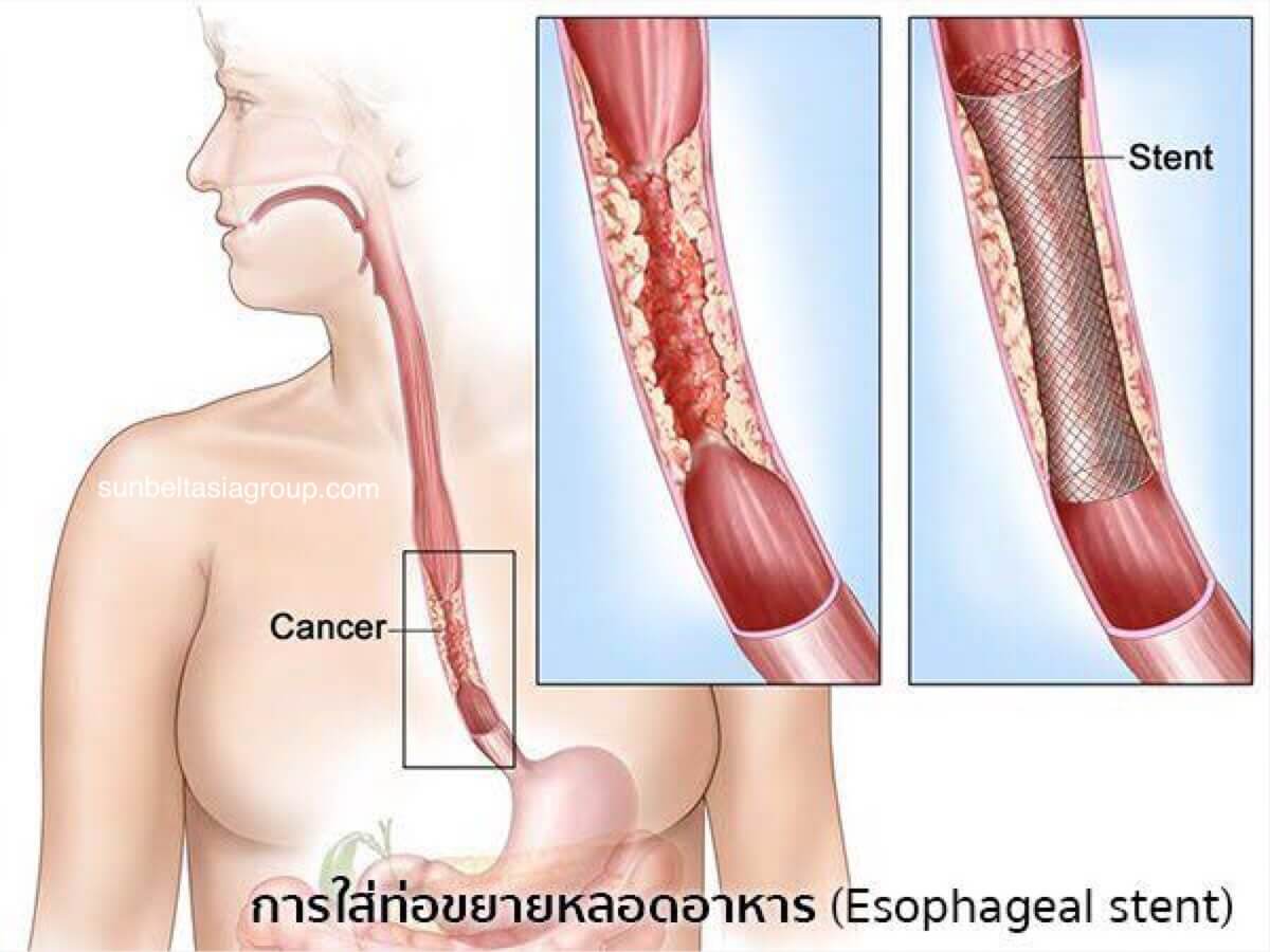 มะเร็งหลอดอาหาร ที่ควรรู้