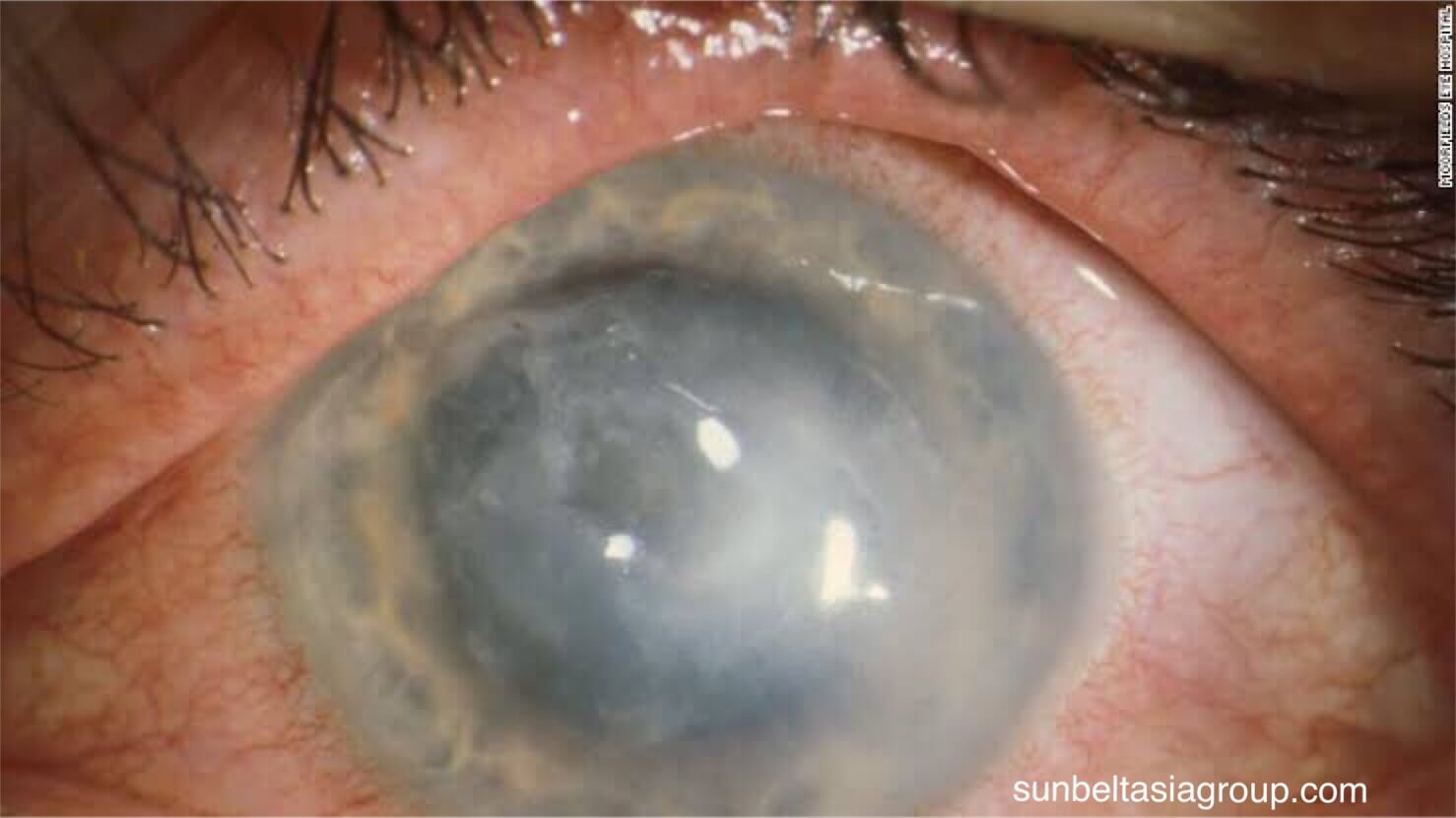 Acanthamoeba keratitis เชื้อร้ายทางสายตา