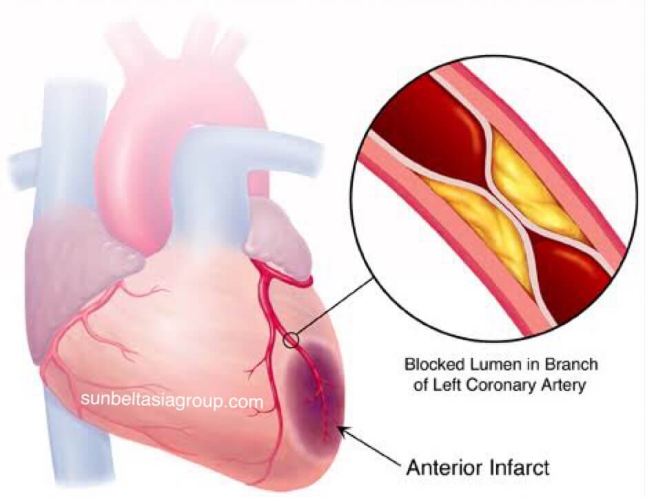 โรคกล้ามเนื้อหัวใจ ที่ทำให้หัวใจสูบฉีดเลือดไปยังส่วนที่เหลือของร่างกายได้ยากขึ้น โรคกล้ามเนื้อหัวใจสามารถนำไปสู่ภาวะหัวใจล้มเหลวได้