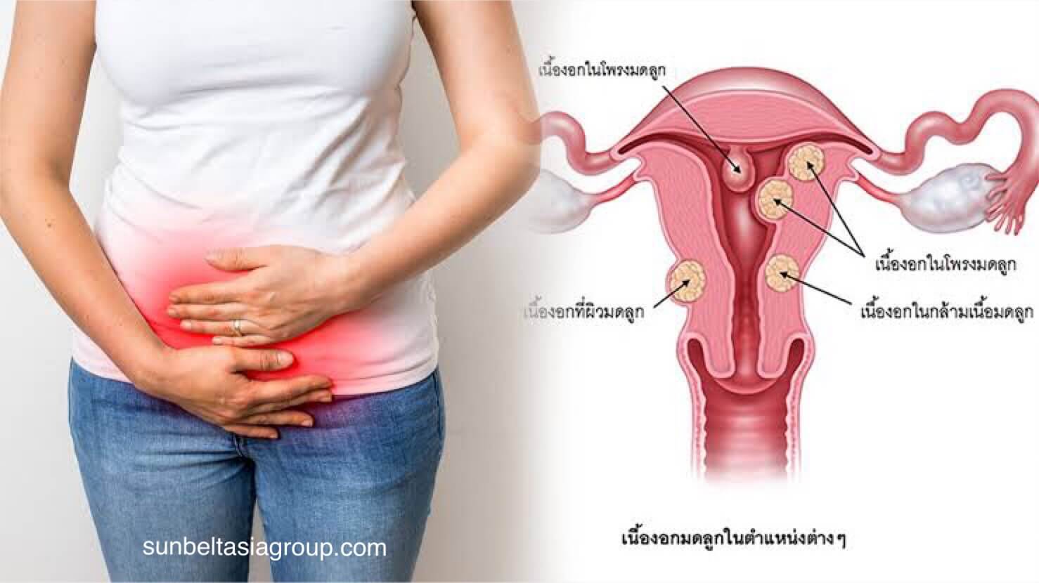 เนื้องอกในมดลูก ในสตรี