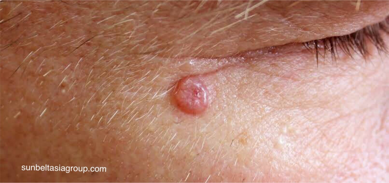 Basal cell carcinoma มะเร็งผิวหนัง