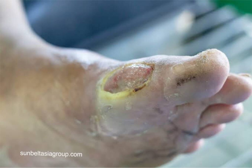 สิ่งเหล่านี้มักเป็นแผลเปิดที่เกิดขึ้นที่ด้านล่างของเท้า ผู้เชี่ยวชาญระบุว่าประมาณ 15% ของผู้ป่วยโรคเบาหวานจะเกิด แผลเบาหวาน ขึ้นใน