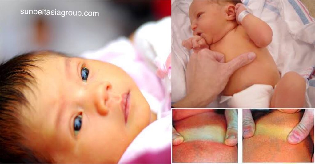 อาการ ตัวเหลืองในทารก คือการที่ผิวหนังและดวงตาของทารกแรกเกิดเปลี่ยนเป็นสีเหลือง อาการตัวเหลืองในทารกเกิดขึ้นเนื่องจากเลือดของ