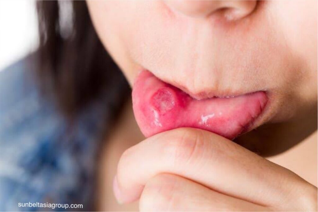 แผลในปาก เป็นแผลขนาดเล็กที่เกิดขึ้นที่เหงือก ริมฝีปาก แก้มด้านในหรือเพดานปาก สิ่งเหล่านี้สามารถกระตุ้นได้จากหลายปัจจัย รวมถึงการบาด