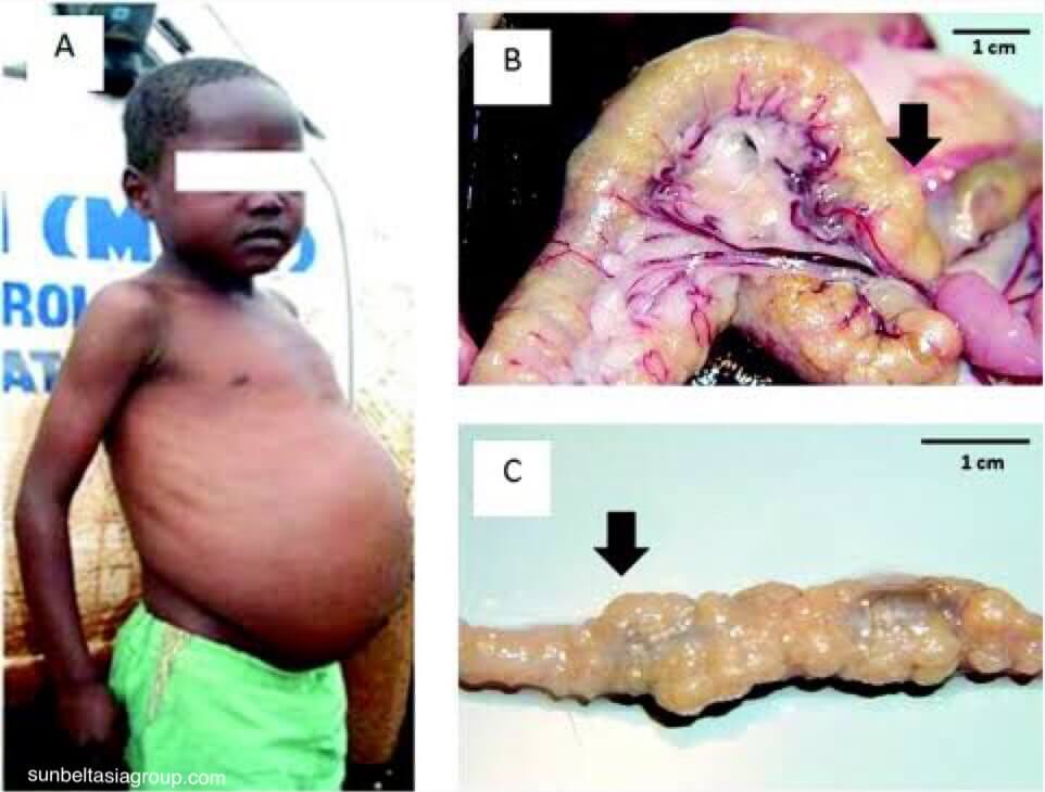 Schistosomiasis เกิดจากพยาธิตัวแบนที่เข้าสู่ผิวหนังของคุณจากแหล่งน้ำที่ติดเชื้อ มีความเกี่ยวข้องกับมะเร็งกระเพาะปัสสาวะ ไม่มีวัคซีน