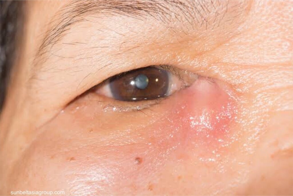 เมื่อคุณมี ท่อน้ำตาอุดตัน น้ำตาของคุณจะไม่สามารถระบายได้ตามปกติ ทำให้คุณน้ำตาไหลและระคายเคืองตา  ท่อน้ำตาอุดตันเป็นเรื่องปกติในเด็กแรกเกิด