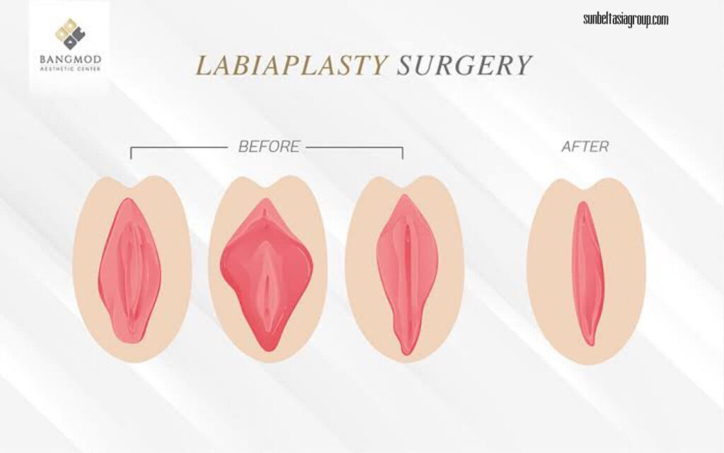 Labiaplasty เป็นวิธีการผ่าตัดที่มักทำเพื่อลดขนาด ปีกผีเสื้อตรงอวัยวะเพศผู้หญิง ผิวหนังที่ล้อมรอบท่อปัสสาวะและช่องคลอดของคุณ ผิวหนัง