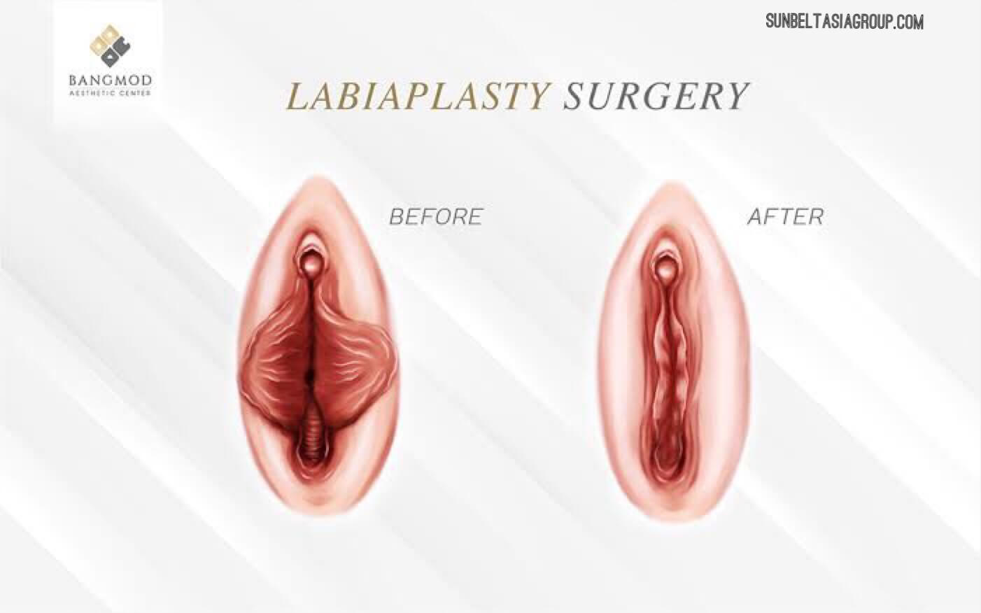 Labiaplasty ปีกผีเสื้อผู้หญิง