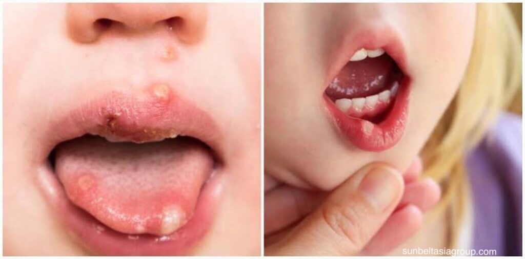 แผลเปื่อย เป็นแผลขนาดเล็กภายในปาก มักพบในริมฝีปาก บนส่วนหลังของเพดานปาก บนแก้ม หรือบนลิ้น ผู้เชี่ยวชาญไม่ทราบสาเหตุ
