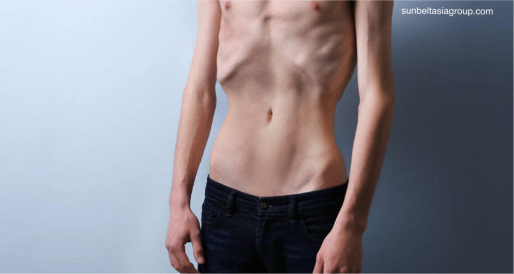 Anorexia nervosa เป็นโรคเกี่ยวกับการกินที่มีลักษณะเฉพาะคือน้ำหนักลด ความยากลำบากในการรักษาน้ำหนักตัวให้เหมาะสมกับส่วนสูง อายุ และสัดส่วน