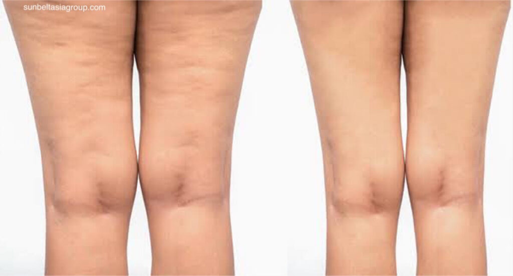 Cellulite เป็นภาวะผิวหนังที่พบได้บ่อยและไม่เป็นอันตราย ซึ่งทำให้เกิดเนื้อนูนเป็นก้อนบริเวณต้นขา สะโพก ก้น และหน้าท้อง ภาวะนี้พบได้บ่อยที่สุด