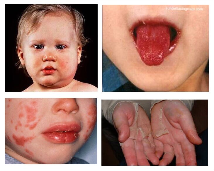 โรคคาวาซากิ ทำให้เกิดอาการบวม ในเด็กที่ผนังหลอดเลือดขนาดเล็กถึงขนาดกลางที่มีเลือดไหลเวียนทั่วร่างกาย โรคคาวาซากิมักนำไปสู่การอักเสบ