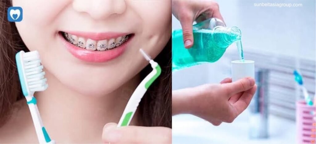 การดูแลทันตกรรมสำหรับผู้ที่จัดฟัน สุขอนามัยช่องปากที่ดีเป็นสิ่งสำคัญอย่างยิ่งเมื่อคุณใส่เหล็กจัดฟัน อาหารและคราบพลัคที่ติดอยู่ภายในหรือรอบๆ