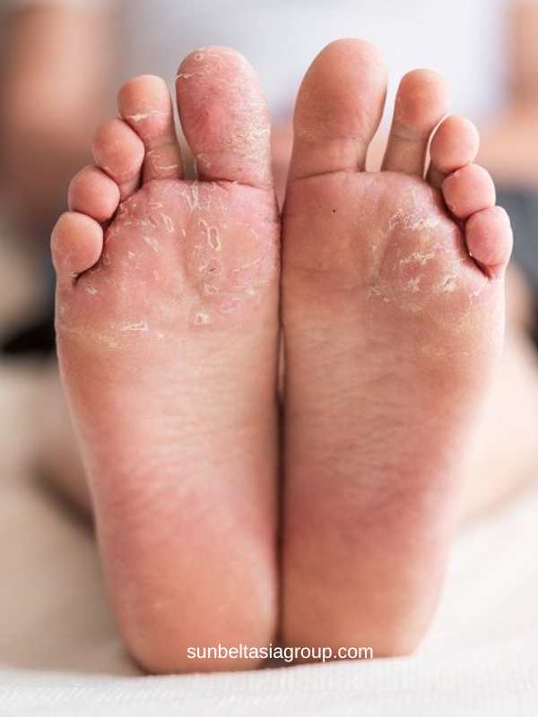 น้ำกัดเท้า (Athlete’s Foot) อาการ สาเหตุ และวิธีรักษา