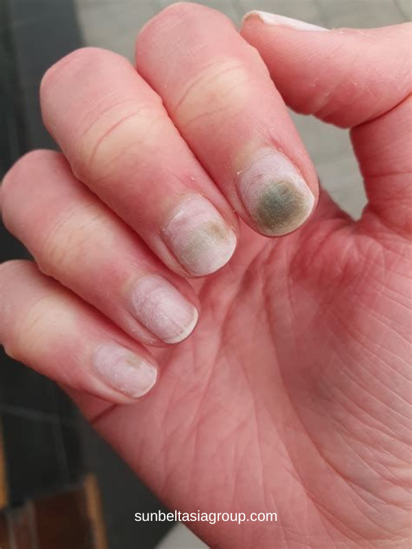เชื้อราที่เล็บ Nail Fungus อาการ วิธีสังเกตุ และวิธีรักษา