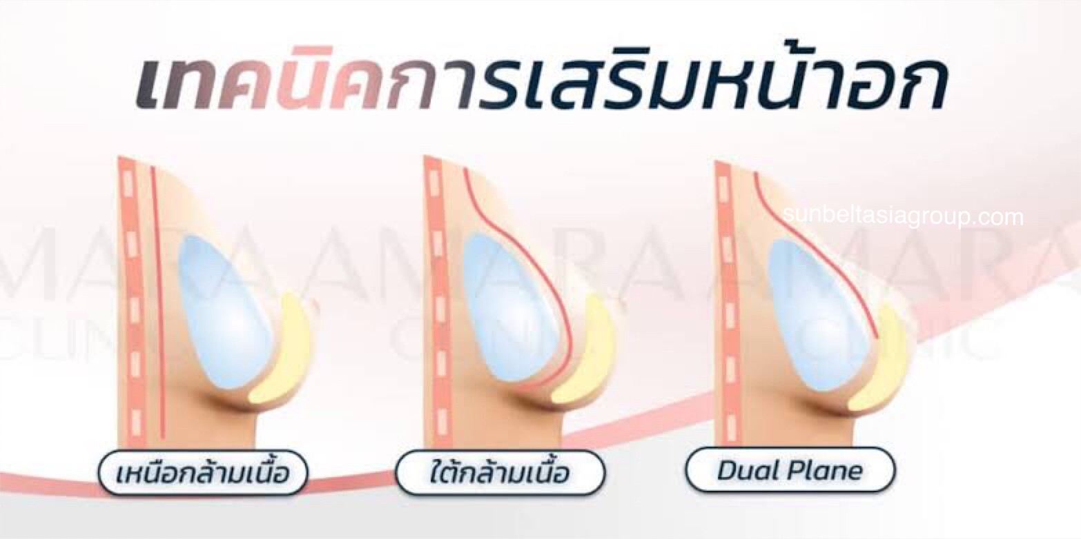 การเสริมหน้าอก เพิ่มความมั่นใจ