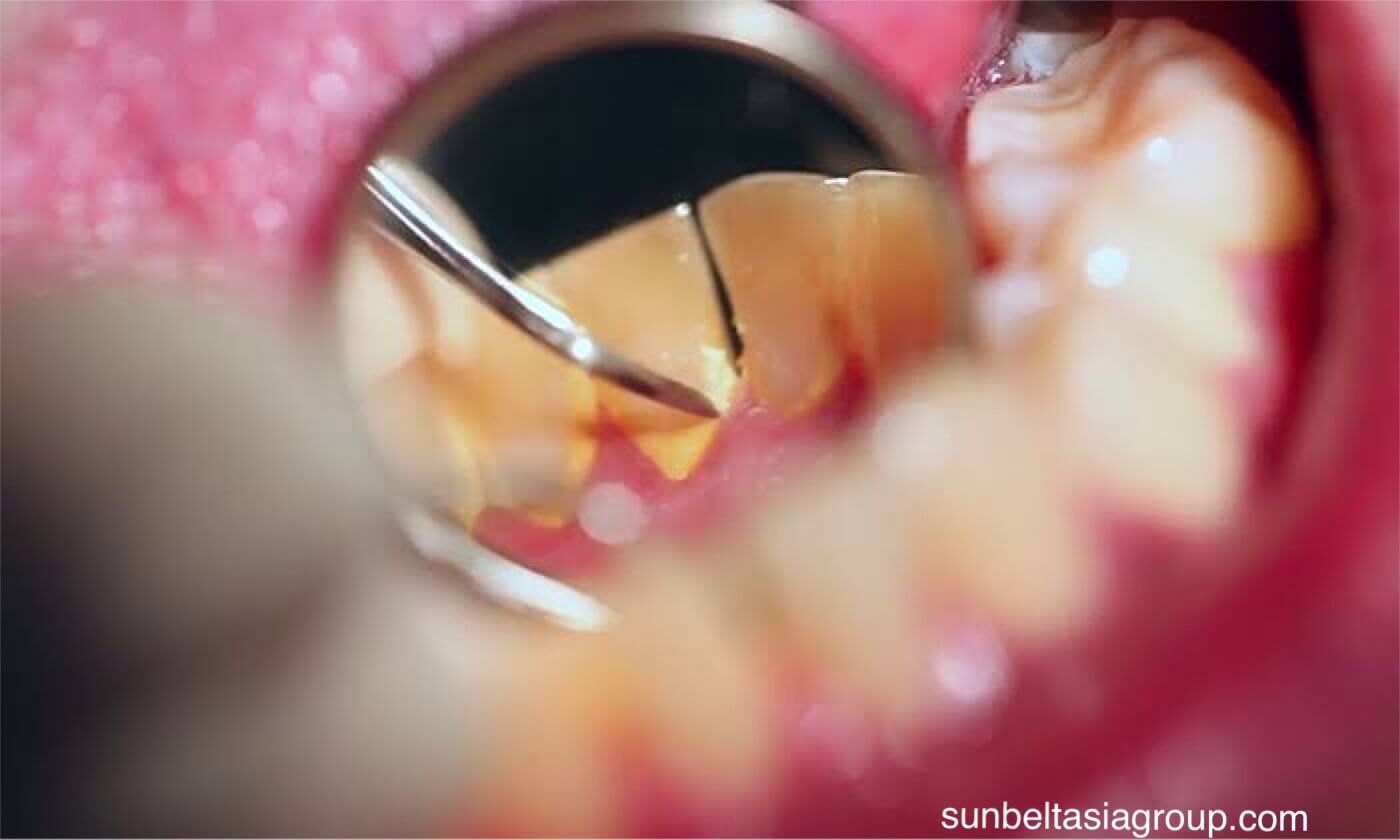 คราบหินปูน ปัญหาสำหรับช่องปาก