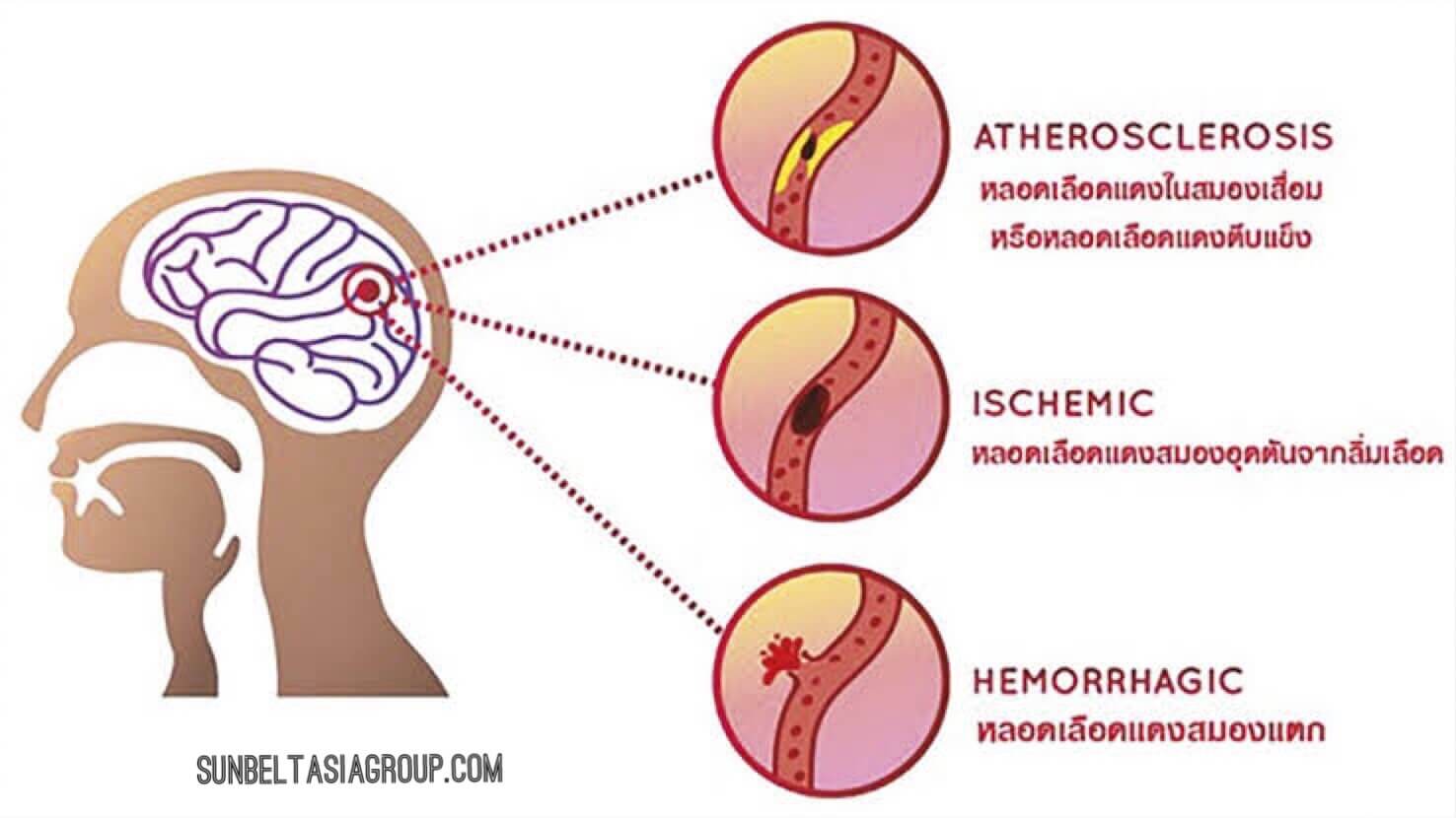 ความสำคัญของสุขภาพหลอดเลือด