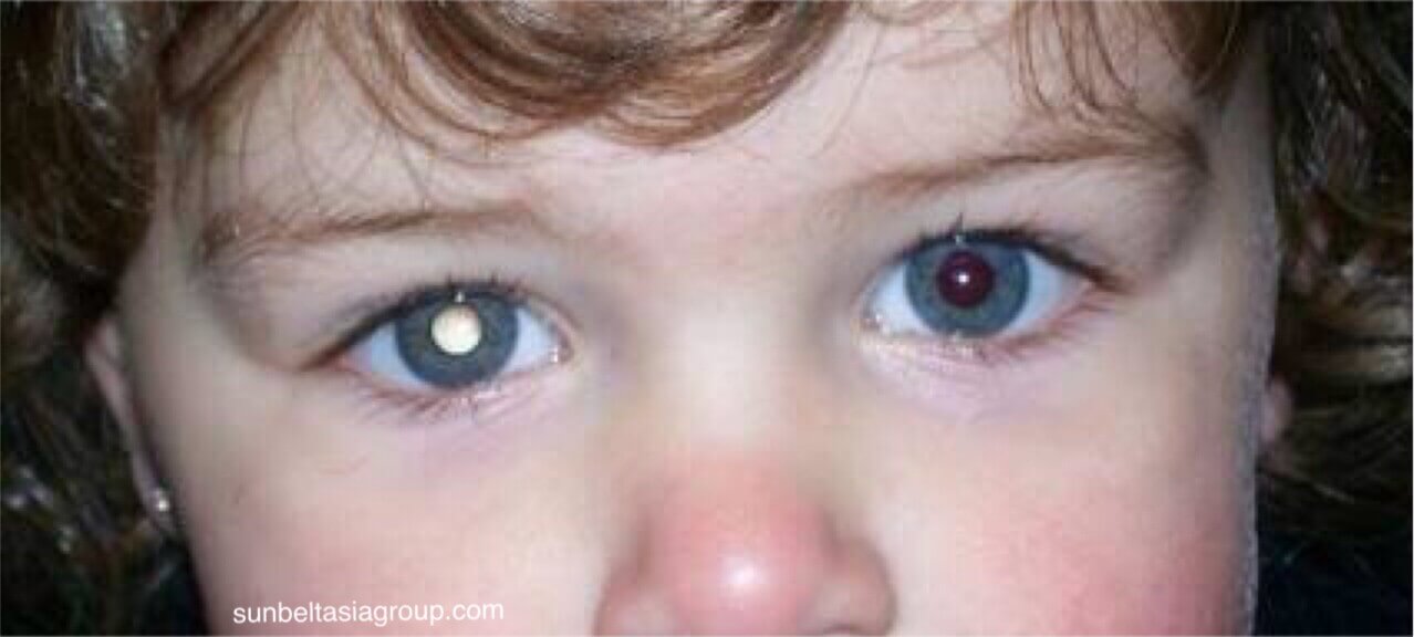 Retinoblastoma