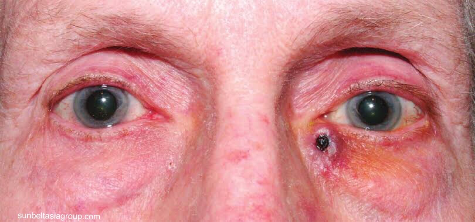 Angiosarcoma